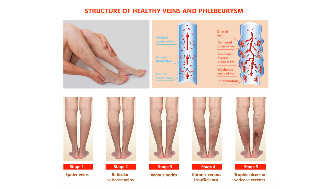 Structure of Varicose Veins
