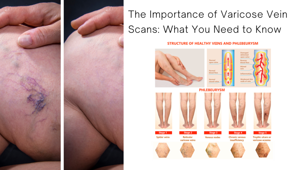 The Importance of Varicose Vein Scans -What You Need to Know