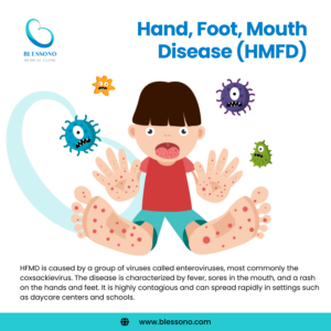 What Parents Need to Know About Hand-Foot-Mouth Disease (HFMD)