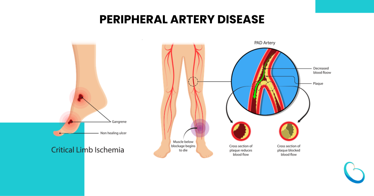 Peripheral Artery Disease - PAD Artery