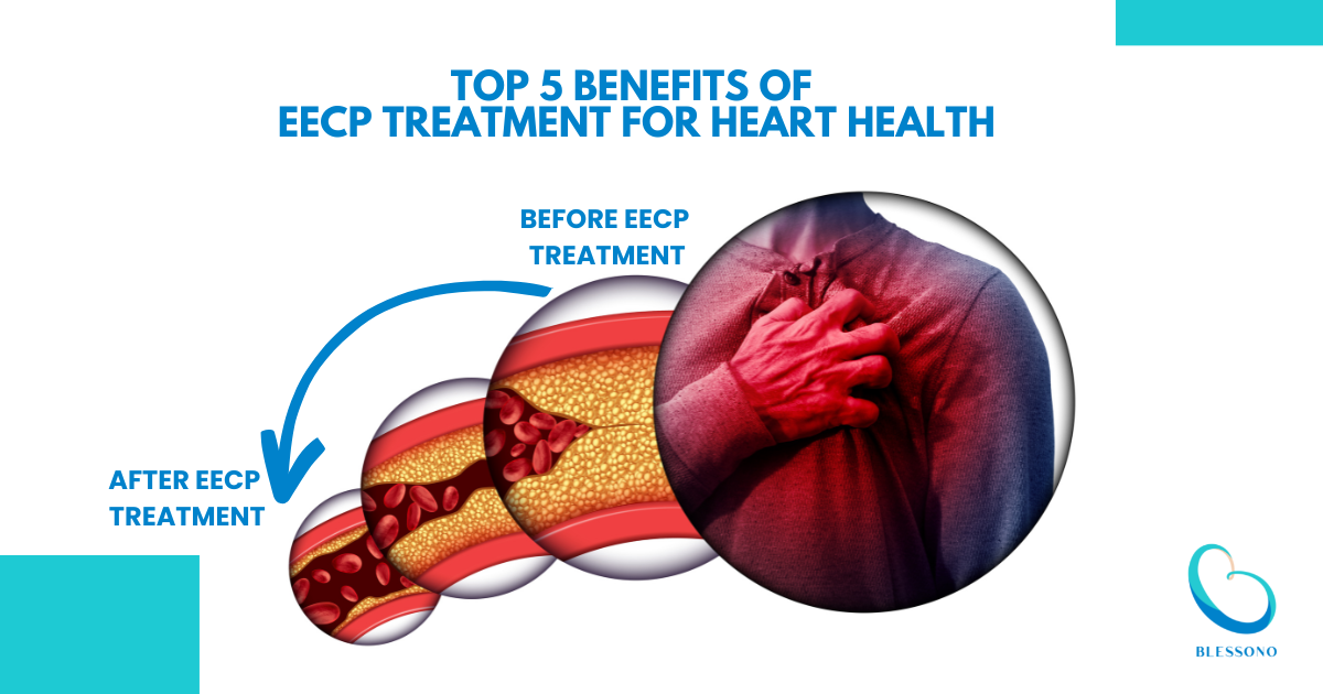 Enhanced External Counterpulsation (EECP) Treatment: A Complete Overview