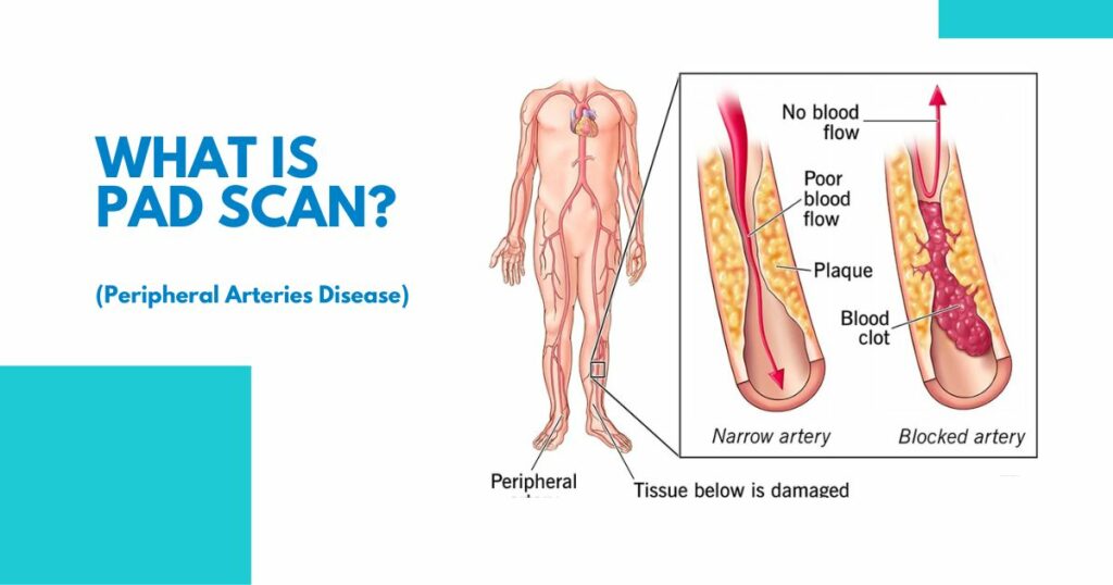 What is Peripheral Arterial Disease (PAD)?