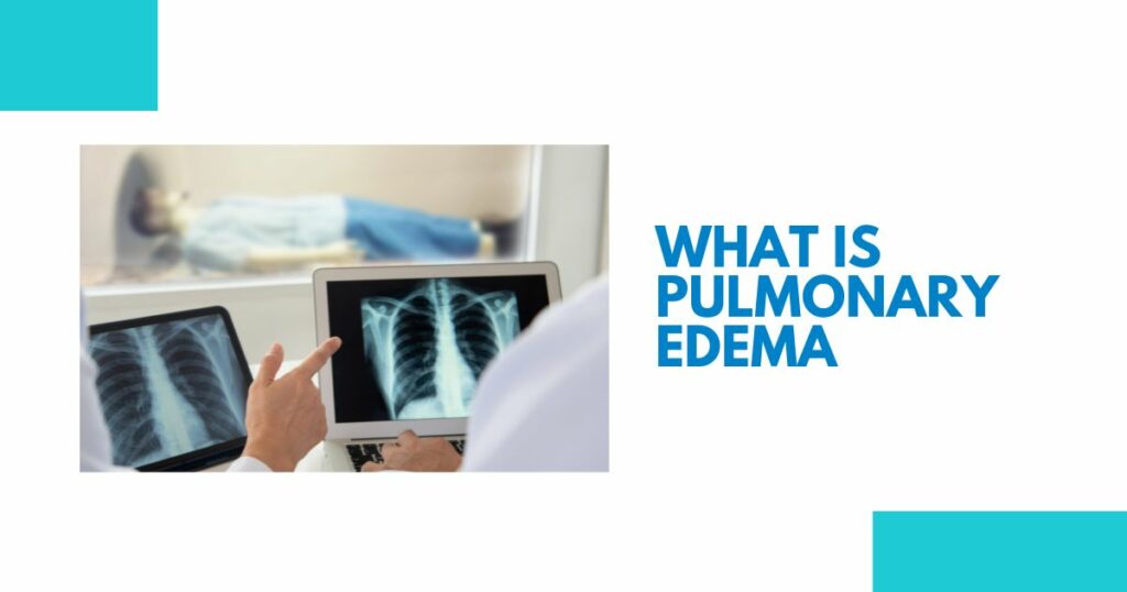 what is pulmonary edema